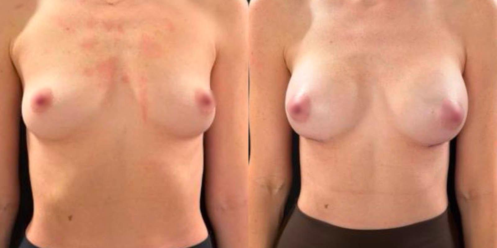 Daniel Mazzaferro, MD breast augmentation result — New York, NY