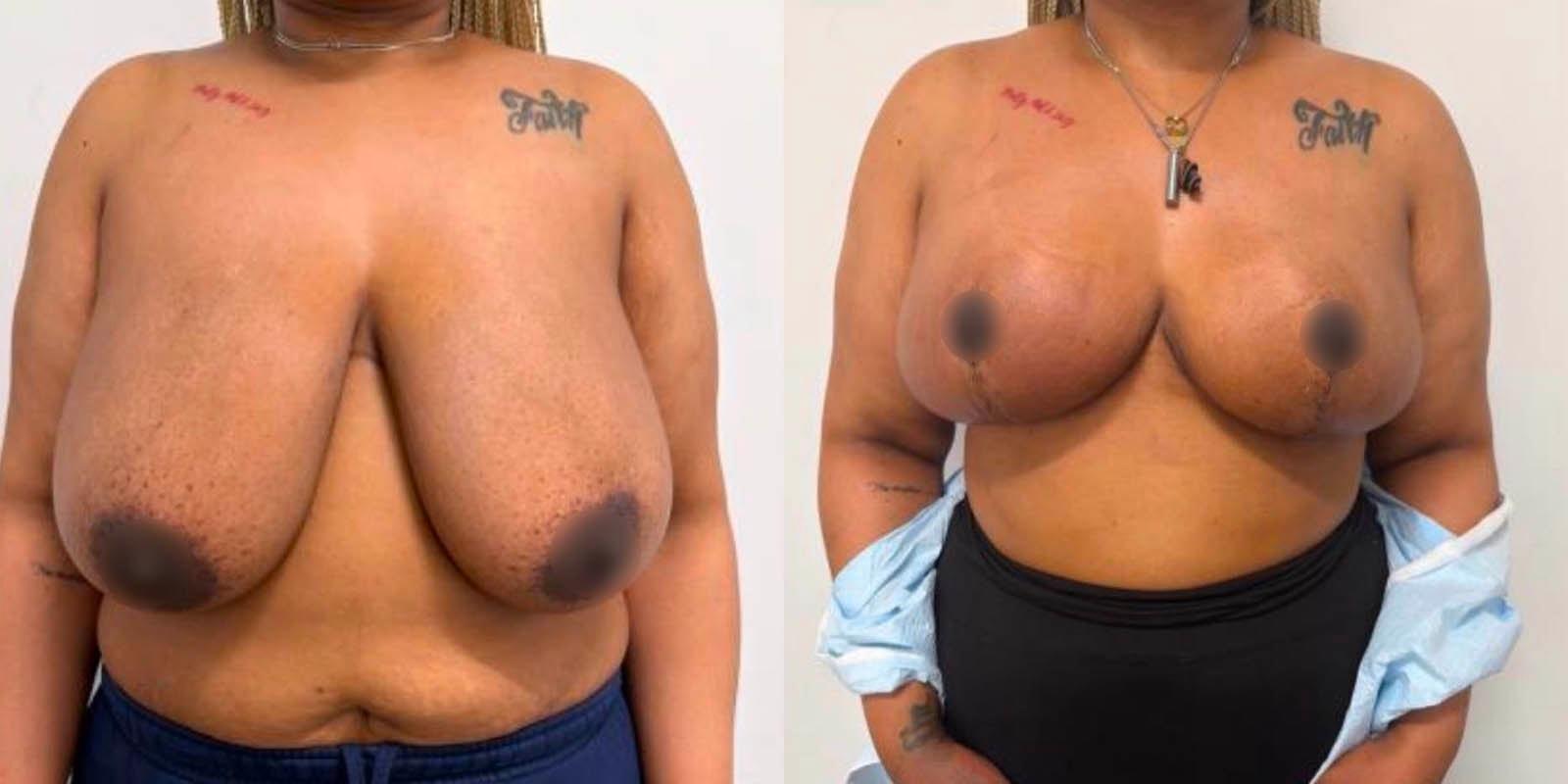 Daniel Mazzaferro, MD breast reduction result — New York, NY