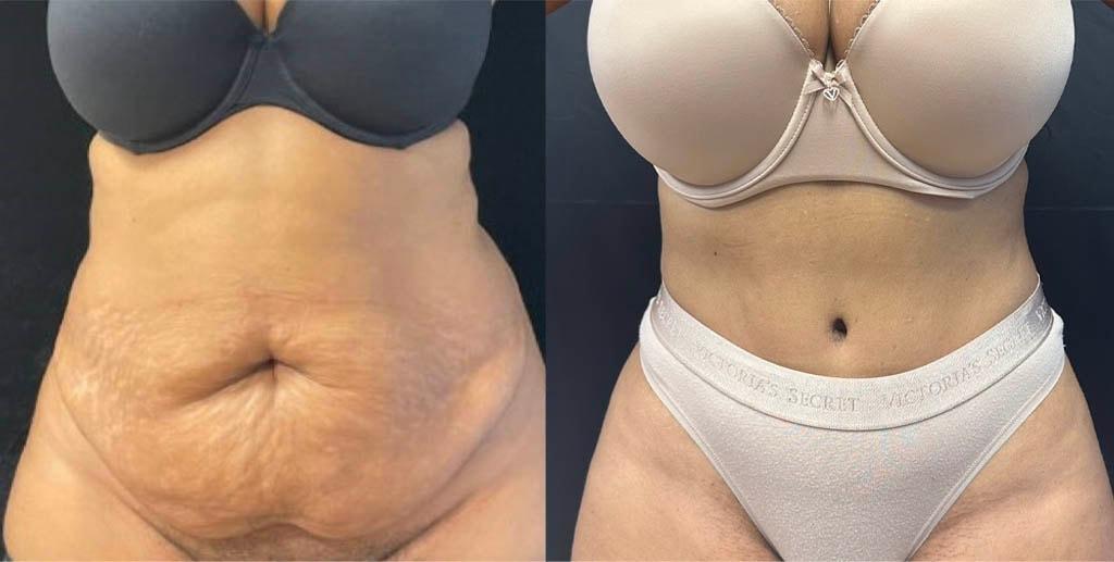 Daniel Mazzaferro, MD tummy tuck result — New York, NY