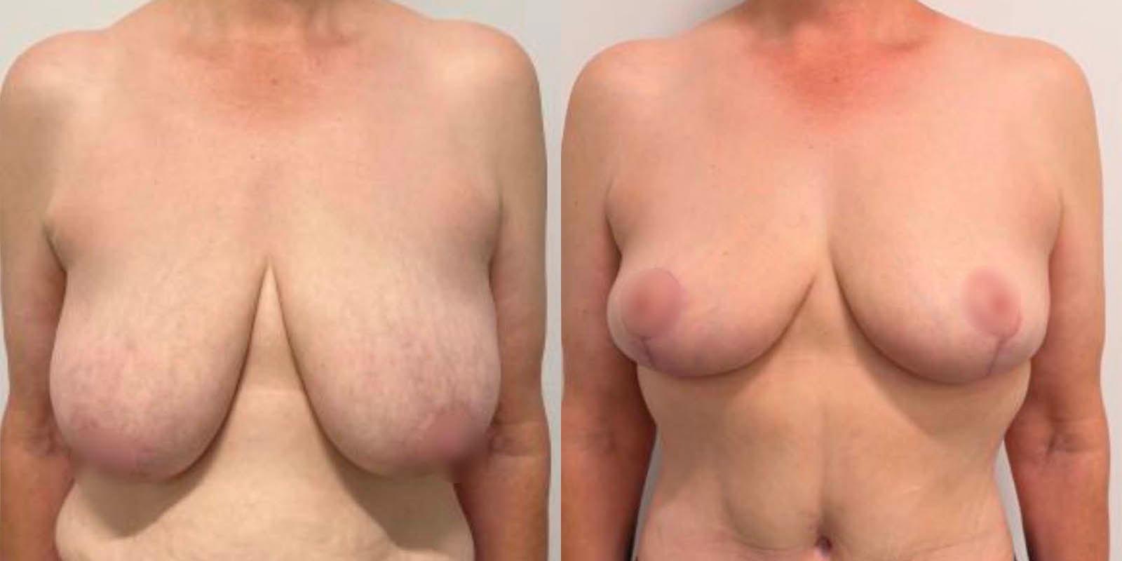 Daniel Mazzaferro, MD breast lift result — New York, NY