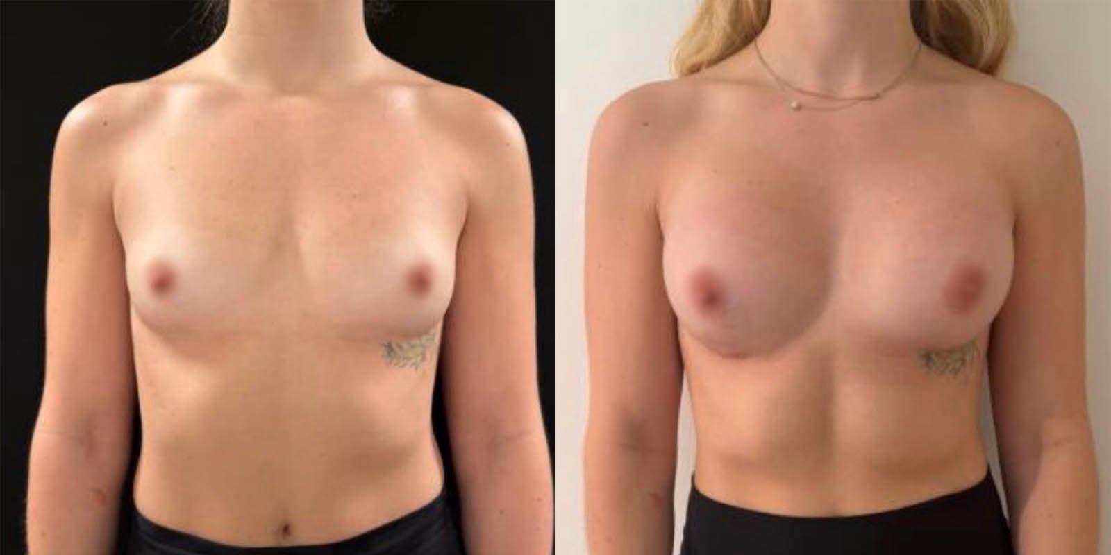 Daniel Mazzaferro, MD breast augmentation result — New York, NY