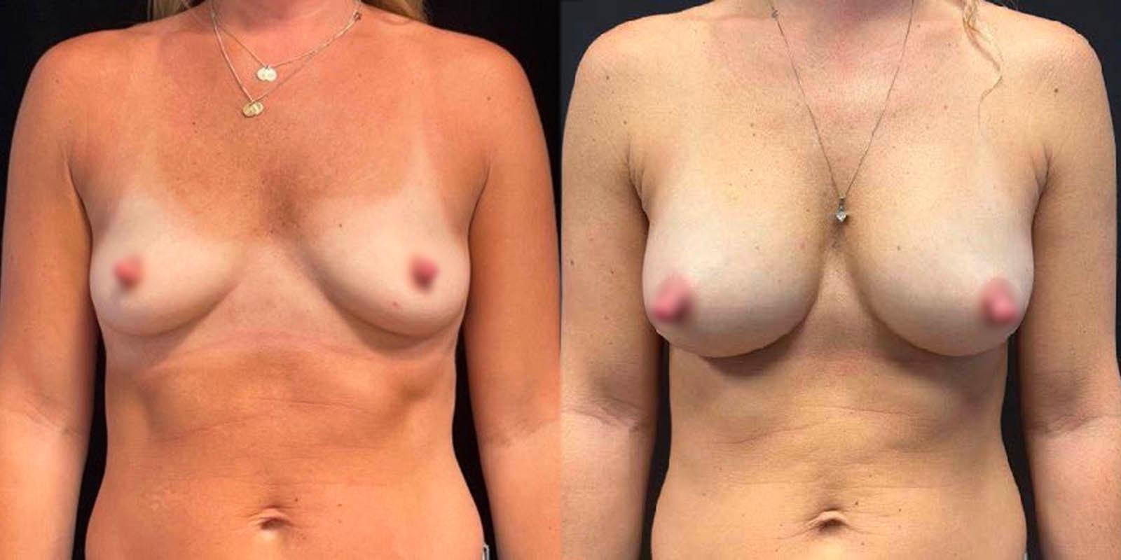 Daniel Mazzaferro, MD breast augmentation result — New York, NY