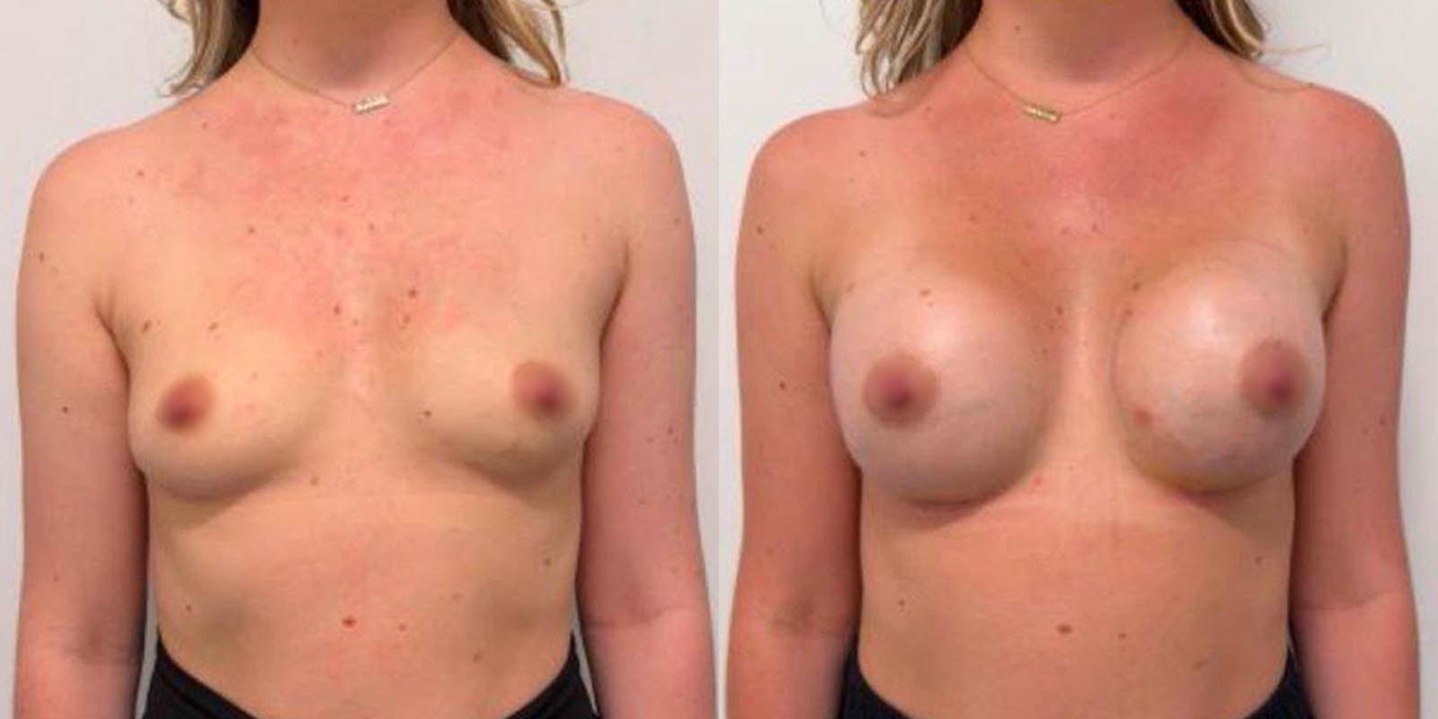 Daniel Mazzaferro, MD breast augmentation result — New York, NY