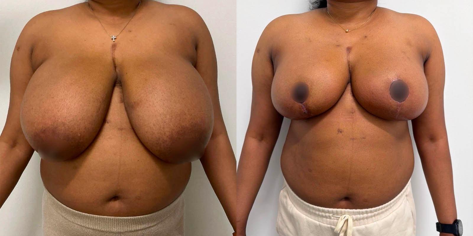 Daniel Mazzaferro, MD breast reduction result — New York, NY