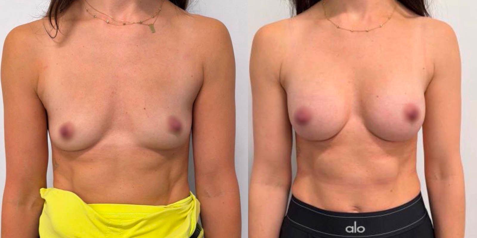 Daniel Mazzaferro, MD breast augmentation result — New York, NY