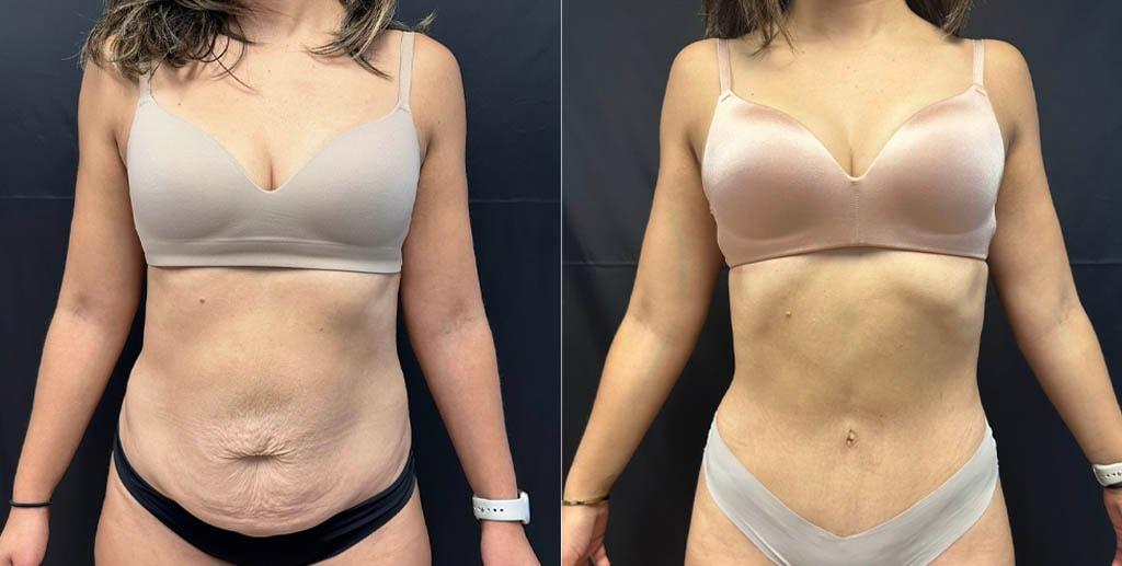 Daniel Mazzaferro, MD tummy tuck result — New York, NY