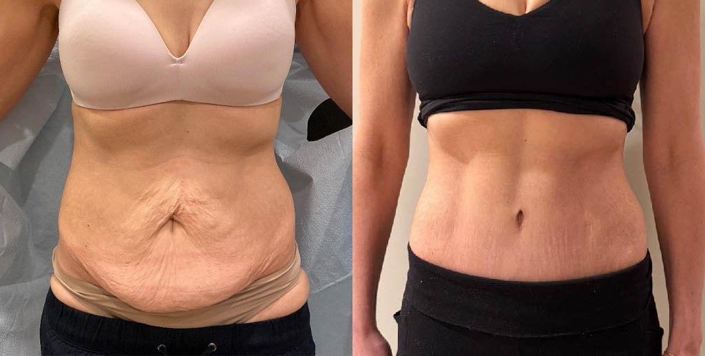 Daniel Mazzaferro, MD tummy tuck result — New York, NY