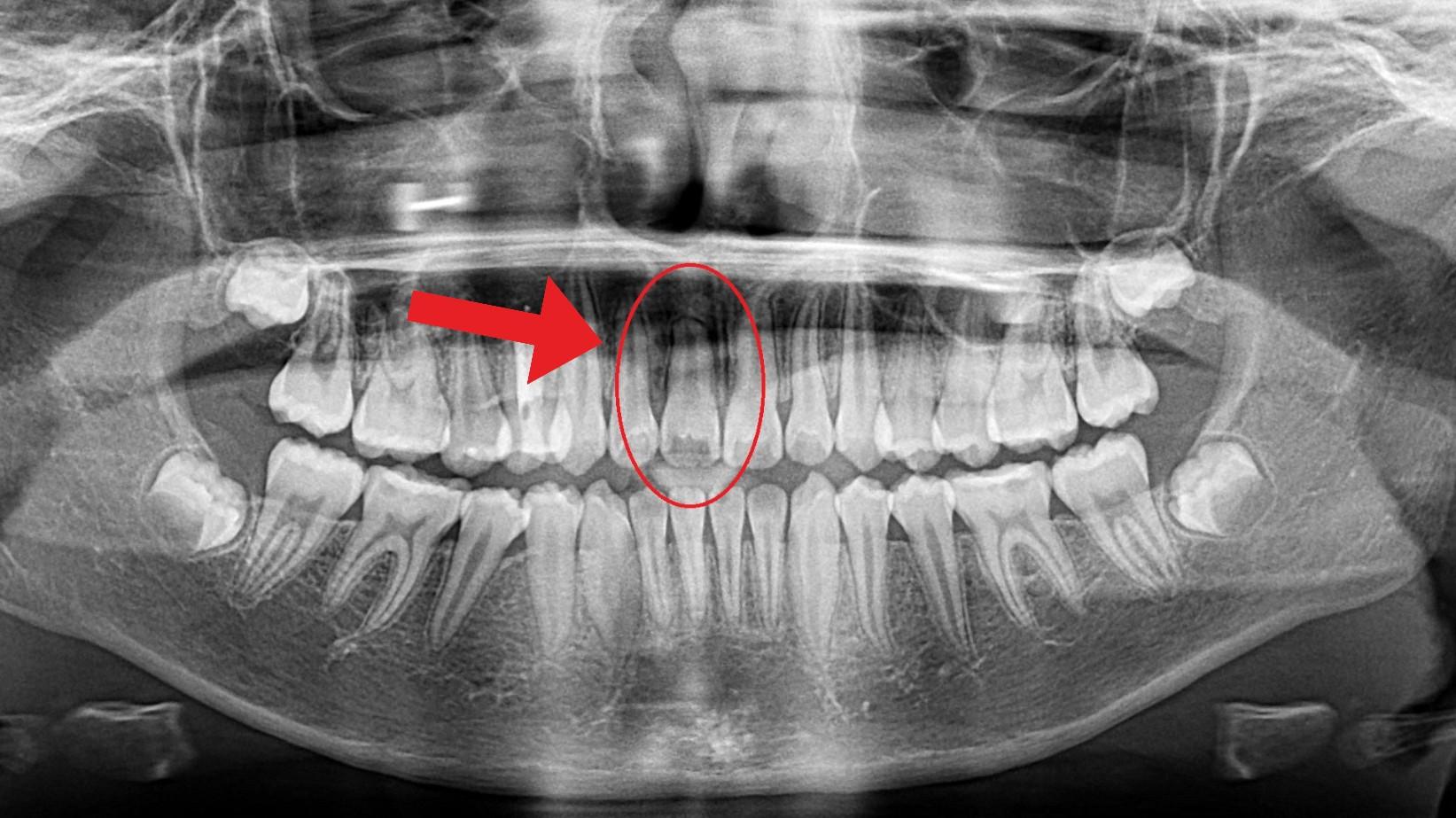 Orem Orthodontics result — Orem, UT