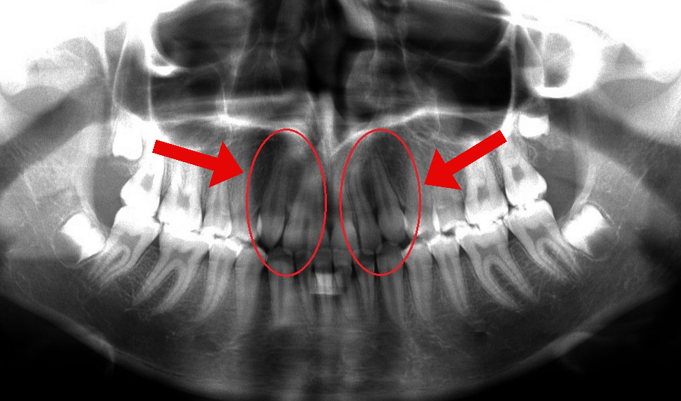 Orem Orthodontics result — Orem, UT