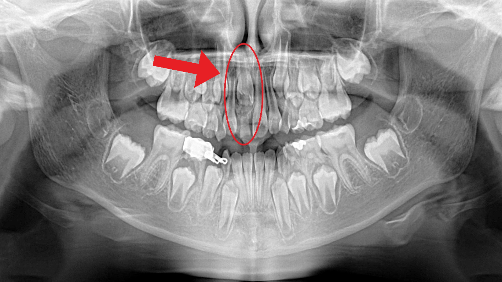 Orem Orthodontics result — Orem, UT