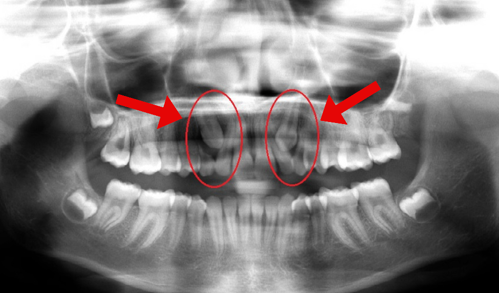 Orem Orthodontics result — Orem, UT