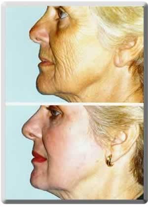 Peter J. Simon, MD laser treatment result — Fort Lauderdale, FL