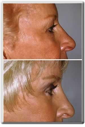 Peter J. Simon, MD eyelid lift result — Fort Lauderdale, FL
