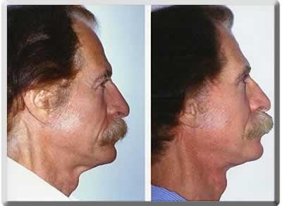 Facelift after at Peter J. Simon, MD in Fort Lauderdale, FL