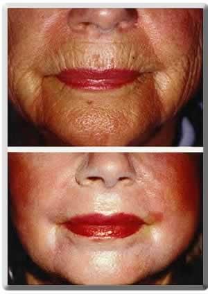 Peter J. Simon, MD laser treatment result — Fort Lauderdale, FL