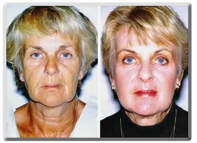 Laser Skin Resurfacing result at Peter J. Simon, MD in Fort Lauderdale, FL