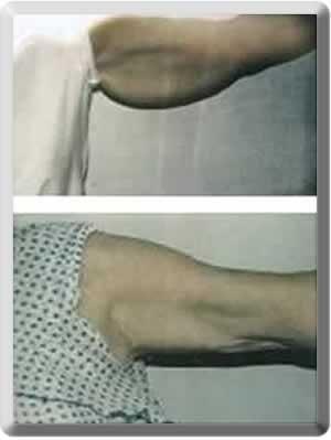 Arm Lift result at Peter J. Simon, MD in Fort Lauderdale, FL