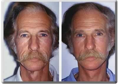 Facelift before at Peter J. Simon, MD in Fort Lauderdale, FL