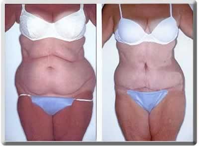 Mommy Makeover result at Peter J. Simon, MD in Fort Lauderdale, FL