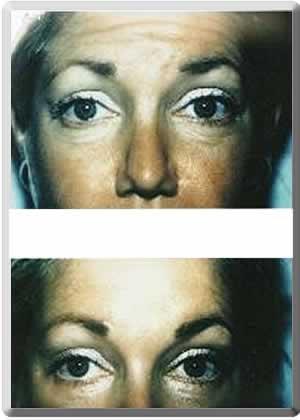 Brow Lift result at Peter J. Simon, MD in Fort Lauderdale, FL