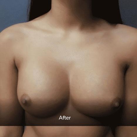 Aesthetic Plastic Surgery & Laser Center, Michelle Hardaway M.D. body contouring after — Farmington Hills, MI