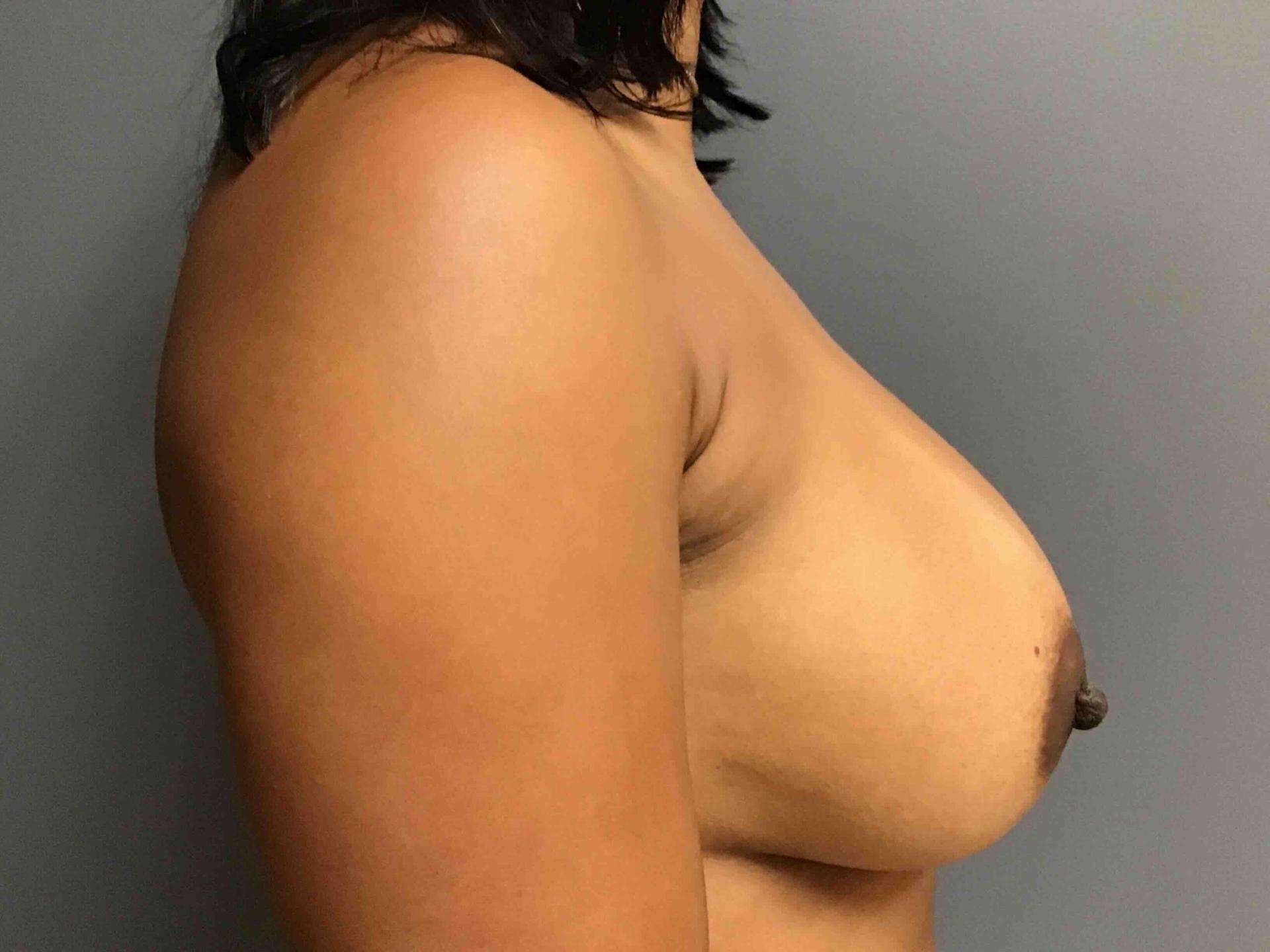 Aesthetic Plastic Surgery & Laser Center, Michelle Hardaway M.D. body contouring after — Farmington Hills, MI