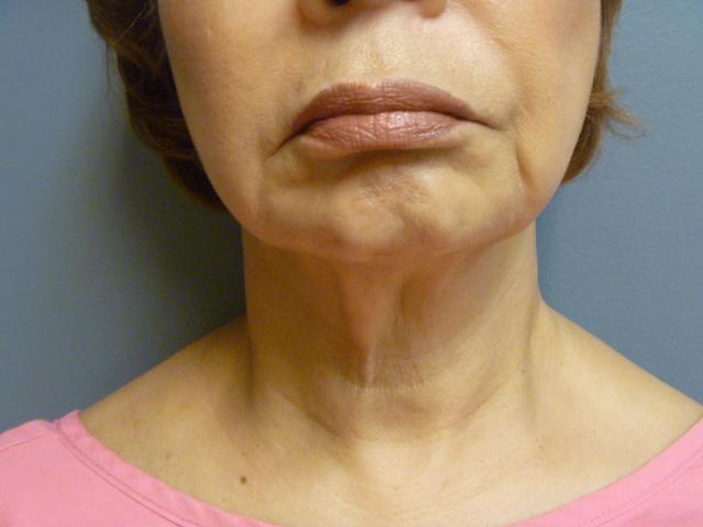 Neck Lift before at Aesthetic Plastic Surgery & Laser Center, Michelle Hardaway M.D. in Farmington Hills, MI
