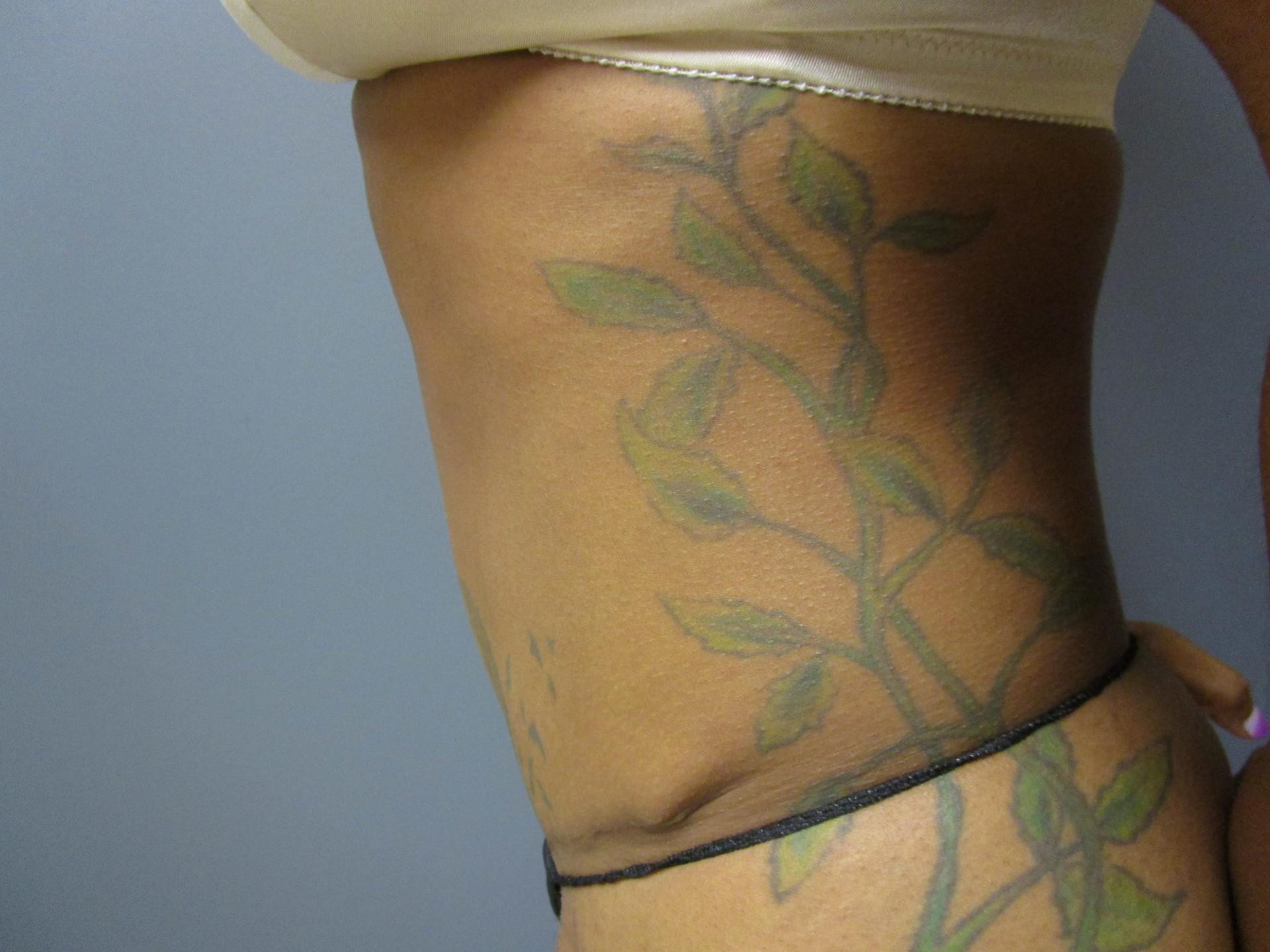 Aesthetic Plastic Surgery & Laser Center, Michelle Hardaway M.D. tummy tuck after — Farmington Hills, MI