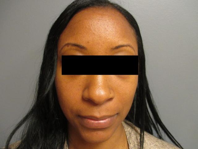 Rhinoplasty before at Aesthetic Plastic Surgery & Laser Center, Michelle Hardaway M.D. in Farmington Hills, MI