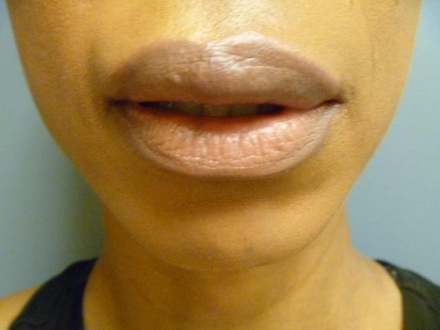 Dermal Fillers after at Aesthetic Plastic Surgery & Laser Center, Michelle Hardaway M.D. in Farmington Hills, MI