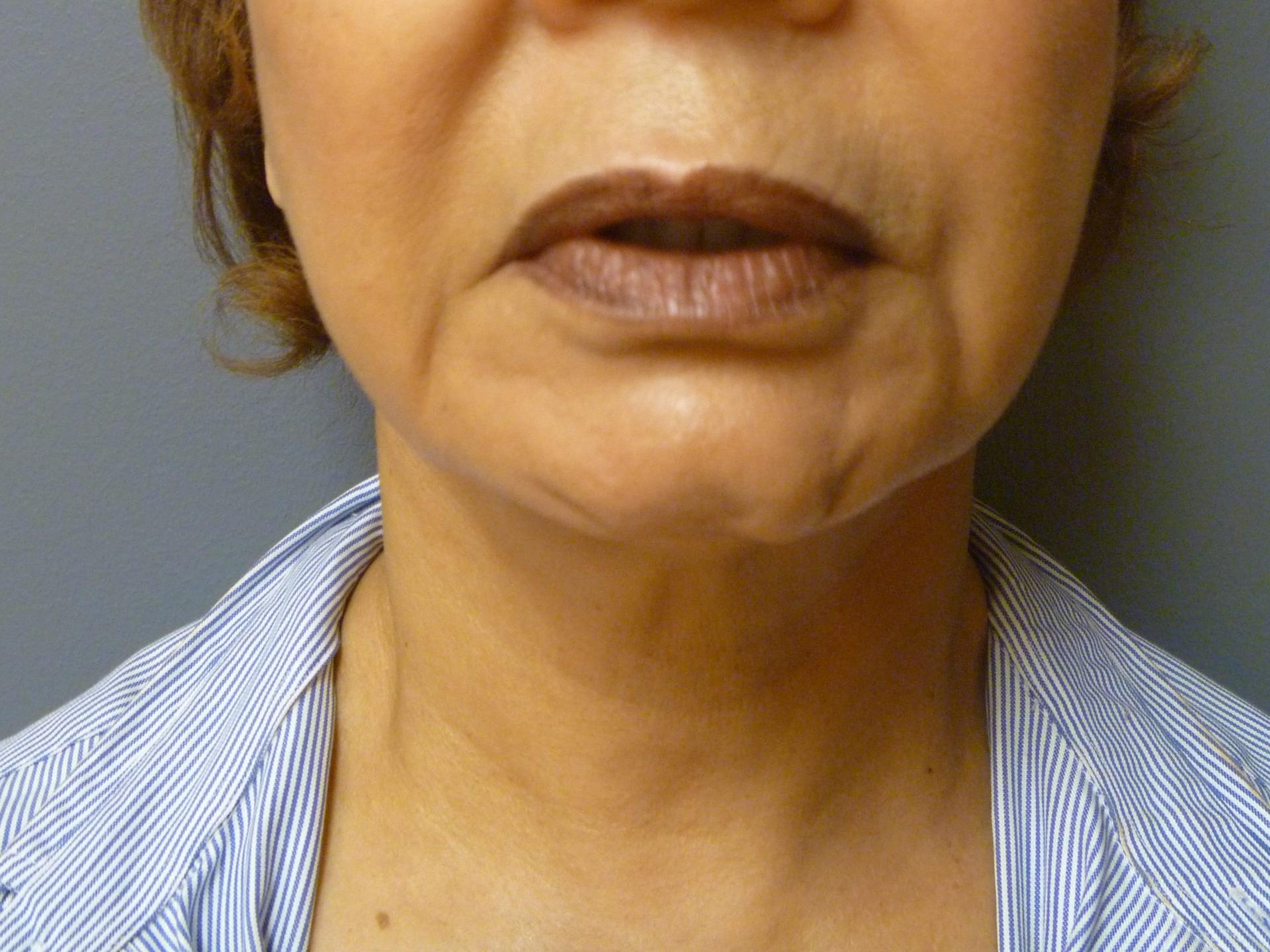 Aesthetic Plastic Surgery & Laser Center, Michelle Hardaway M.D. neck lift after — Farmington Hills, MI