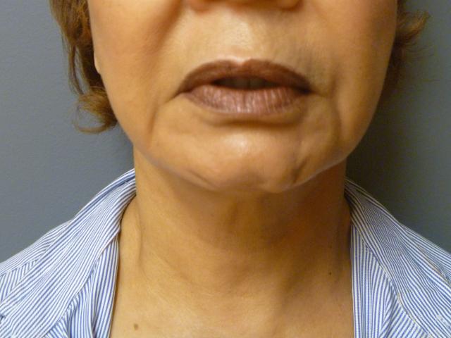 Neck Lift after at Aesthetic Plastic Surgery & Laser Center, Michelle Hardaway M.D. in Farmington Hills, MI
