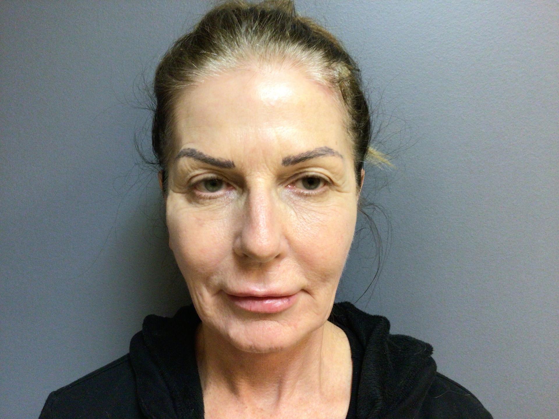 Aesthetic Plastic Surgery & Laser Center, Michelle Hardaway M.D. blepharoplasty after — Farmington Hills, MI