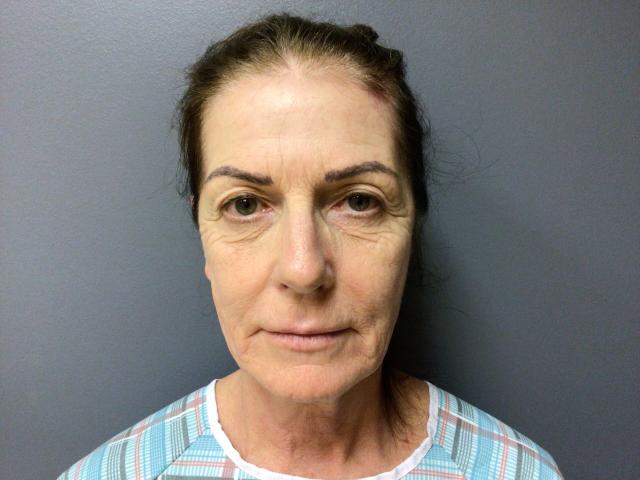 Blepharoplasty before at Aesthetic Plastic Surgery & Laser Center, Michelle Hardaway M.D. in Farmington Hills, MI