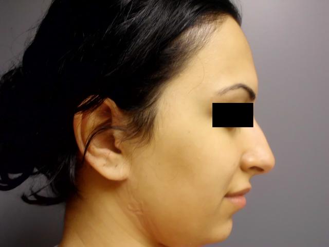 Rhinoplasty before at Aesthetic Plastic Surgery & Laser Center, Michelle Hardaway M.D. in Farmington Hills, MI