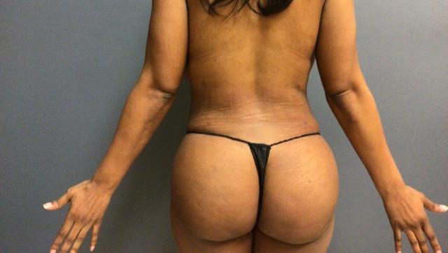 Liposuction result at Aesthetic Plastic Surgery & Laser Center, Michelle Hardaway M.D. in Farmington Hills, MI