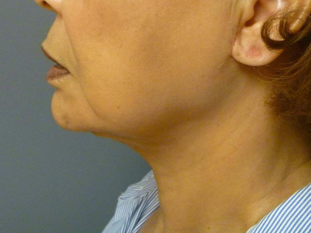 Neck Lift after at Aesthetic Plastic Surgery & Laser Center, Michelle Hardaway M.D. in Farmington Hills, MI