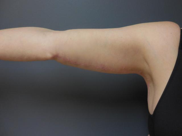 Arm Lift after at Aesthetic Plastic Surgery & Laser Center, Michelle Hardaway M.D. in Farmington Hills, MI