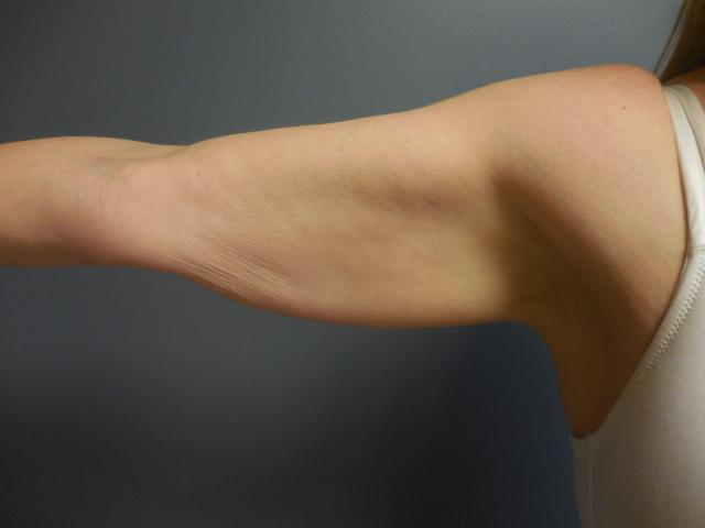 Arm Lift before at Aesthetic Plastic Surgery & Laser Center, Michelle Hardaway M.D. in Farmington Hills, MI