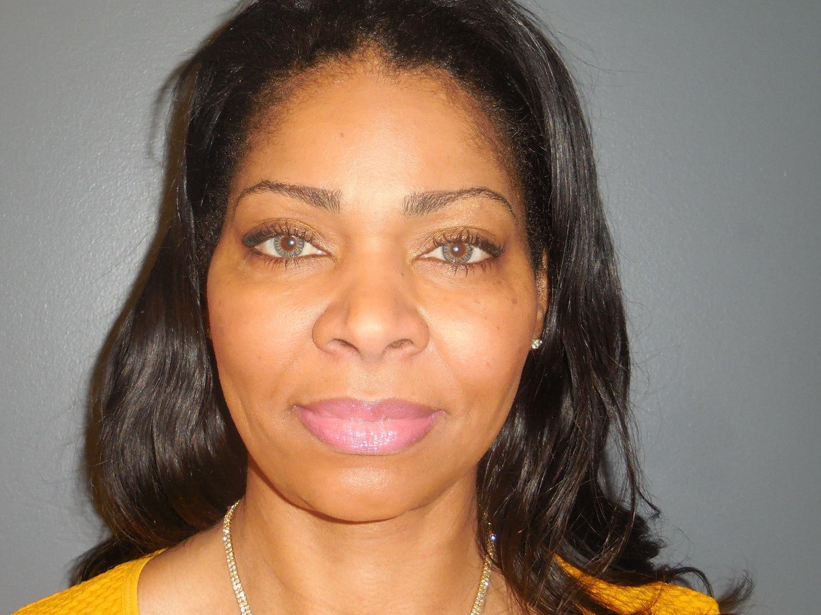 Aesthetic Plastic Surgery & Laser Center, Michelle Hardaway M.D. fat transfer after — Farmington Hills, MI