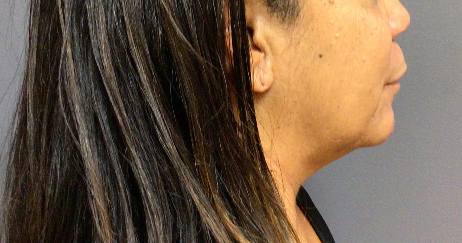 Aesthetic Plastic Surgery & Laser Center, Michelle Hardaway M.D. body contouring result — Farmington Hills, MI
