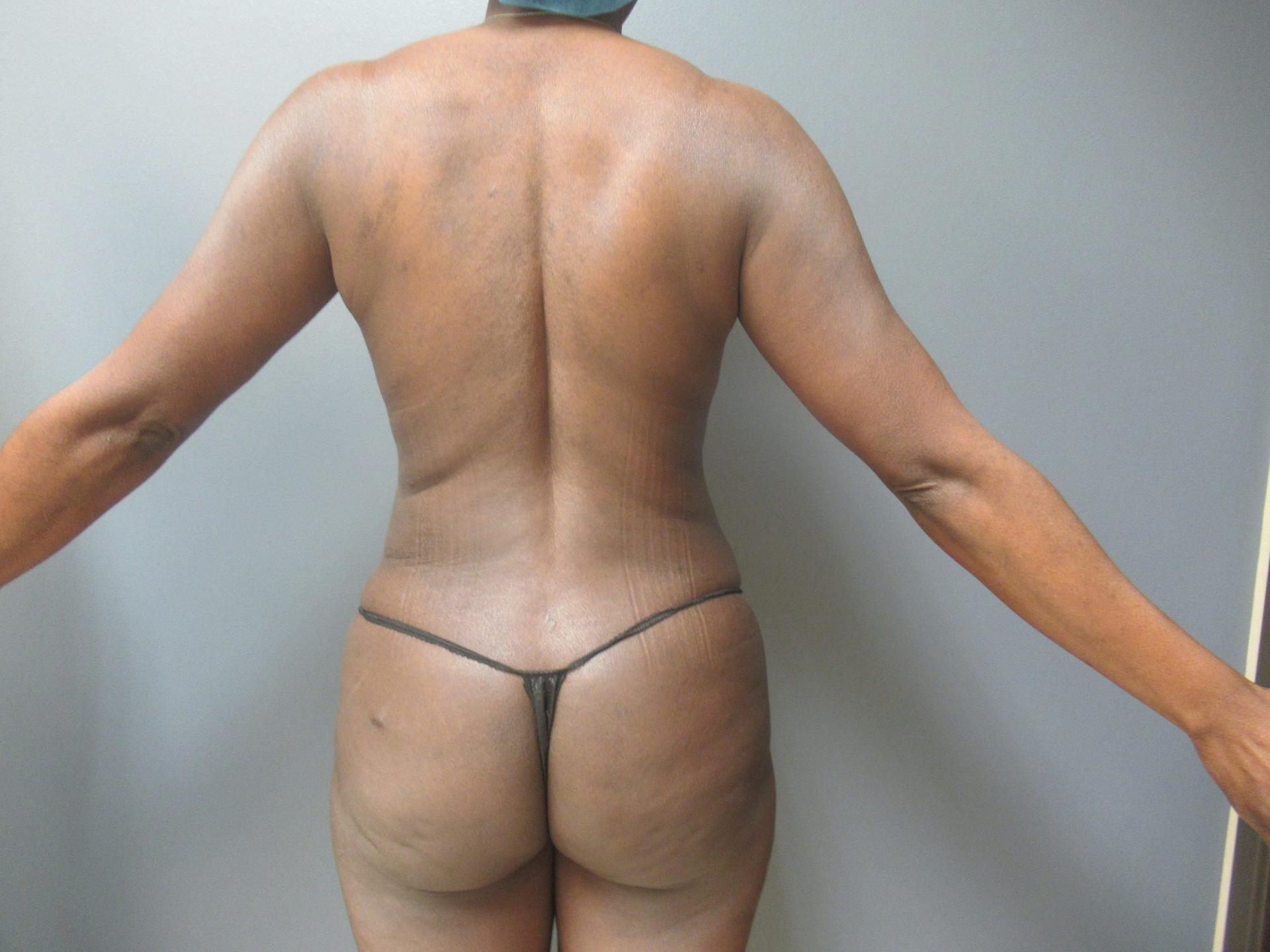 Aesthetic Plastic Surgery & Laser Center, Michelle Hardaway M.D. liposuction after — Farmington Hills, MI