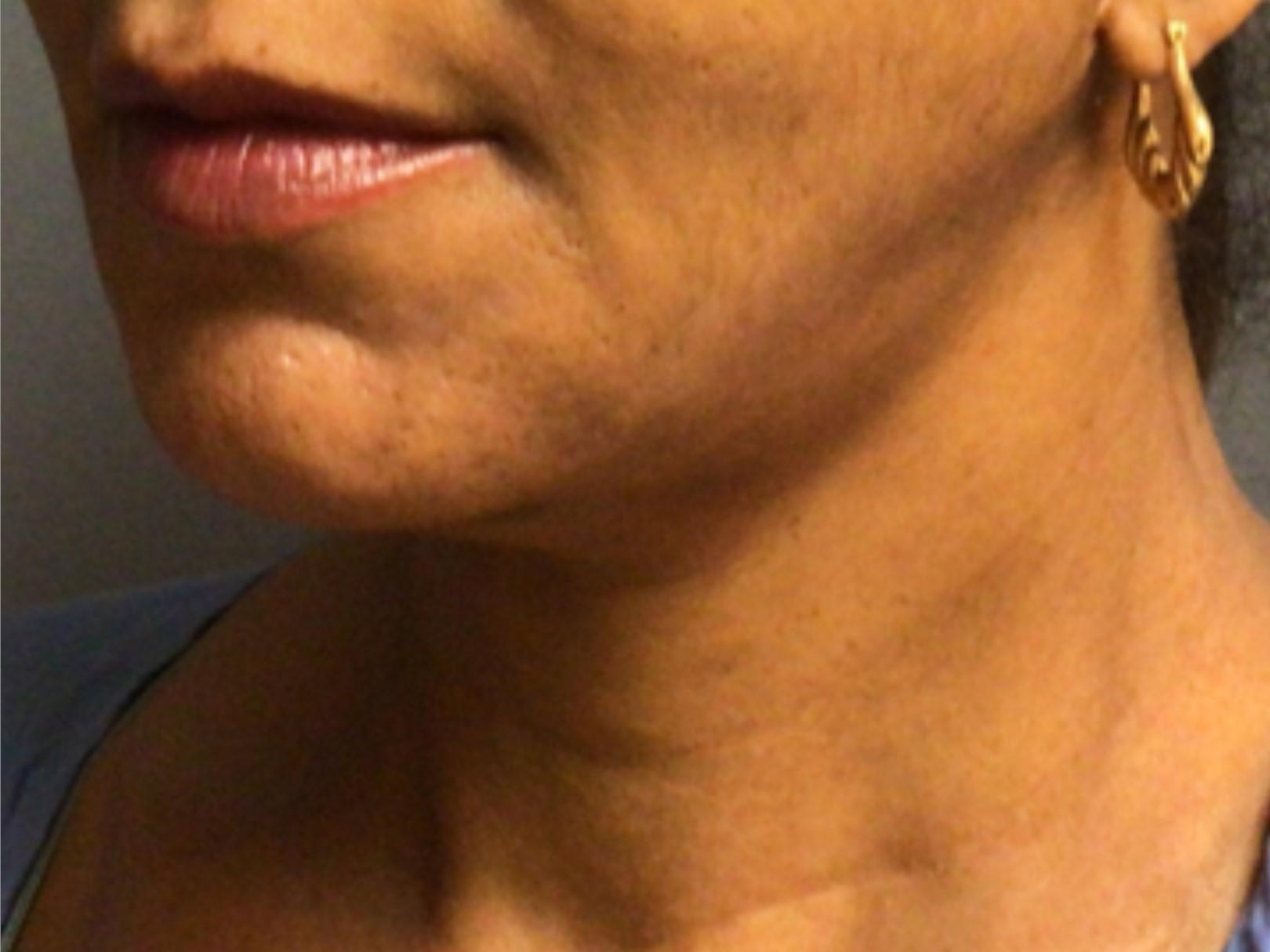 Aesthetic Plastic Surgery & Laser Center, Michelle Hardaway M.D. body contouring after — Farmington Hills, MI