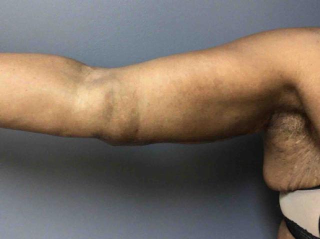 Arm Lift after at Aesthetic Plastic Surgery & Laser Center, Michelle Hardaway M.D. in Farmington Hills, MI