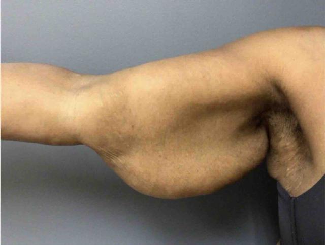 Arm Lift before at Aesthetic Plastic Surgery & Laser Center, Michelle Hardaway M.D. in Farmington Hills, MI