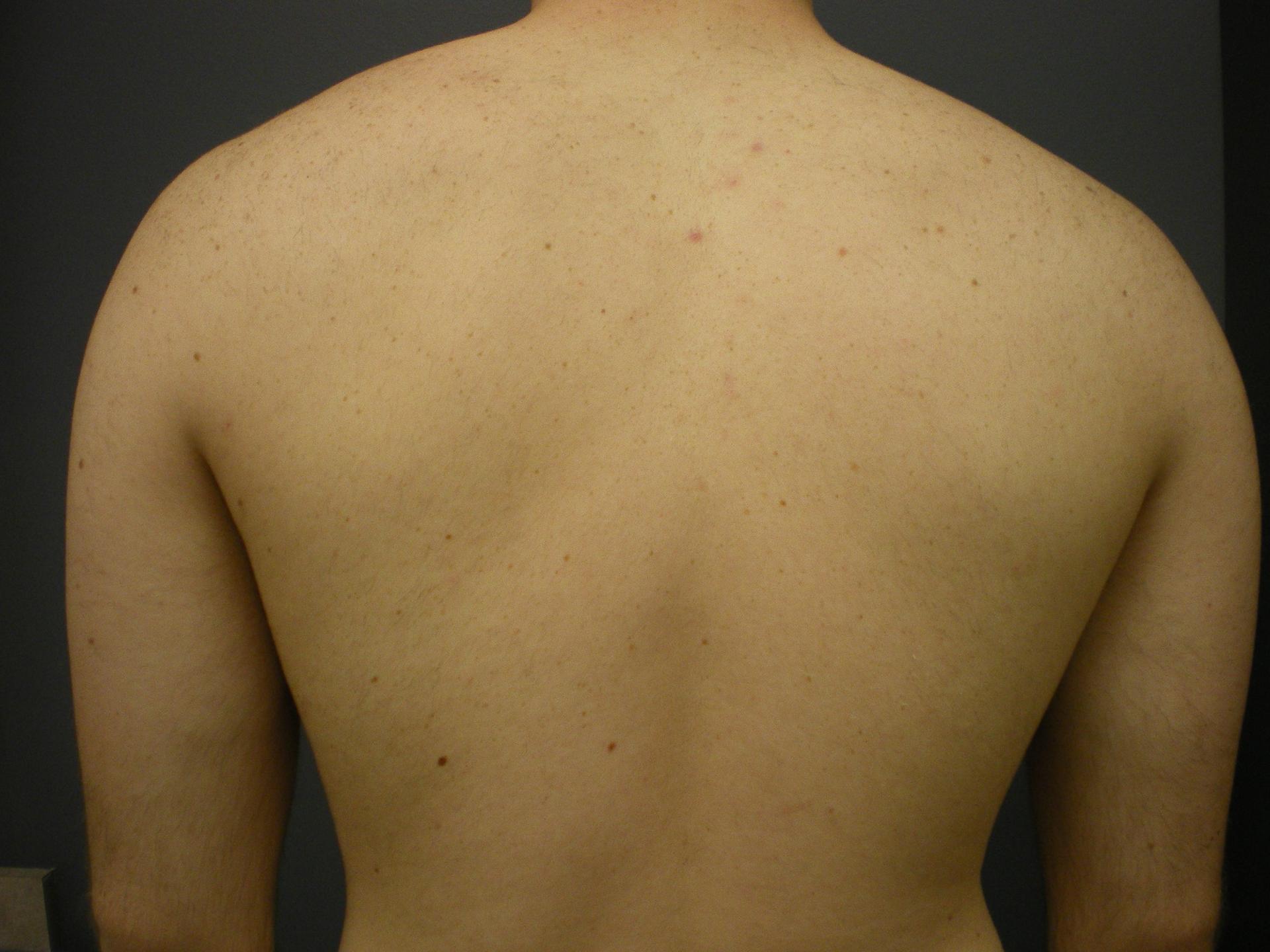 Aesthetic Plastic Surgery & Laser Center, Michelle Hardaway M.D. laser treatment after — Farmington Hills, MI