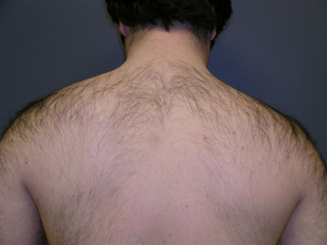 Morpheus8 before at Aesthetic Plastic Surgery & Laser Center, Michelle Hardaway M.D. in Farmington Hills, MI