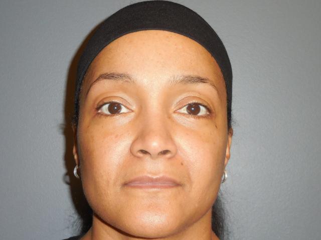 Blepharoplasty after at Aesthetic Plastic Surgery & Laser Center, Michelle Hardaway M.D. in Farmington Hills, MI