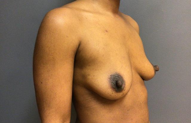 Breast Augmentation before at Aesthetic Plastic Surgery & Laser Center, Michelle Hardaway M.D. in Farmington Hills, MI