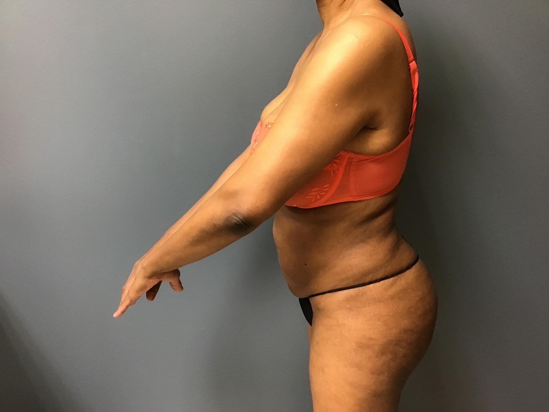 Aesthetic Plastic Surgery & Laser Center, Michelle Hardaway M.D. bbl after — Farmington Hills, MI